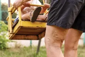 Do Varicose Veins Indicate Poor Health?